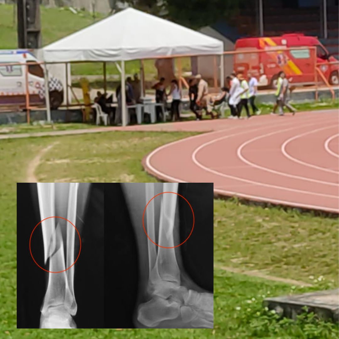 Candidata quebra as pernas em TAF do concurso do Corpo de Bombeiros em Manaus