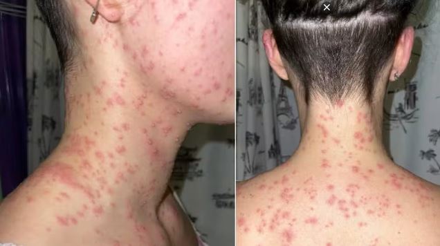 Mulher processa polícia após ser algemada com o rosto em formigueiro