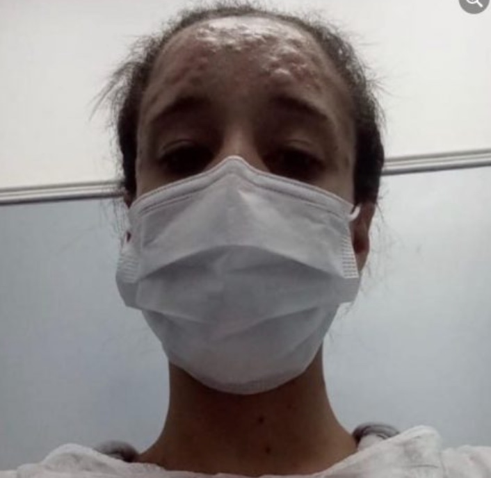 Em vídeo, mulher com suspeita de varíola dos macacos mostra bolhas e relata sintomas