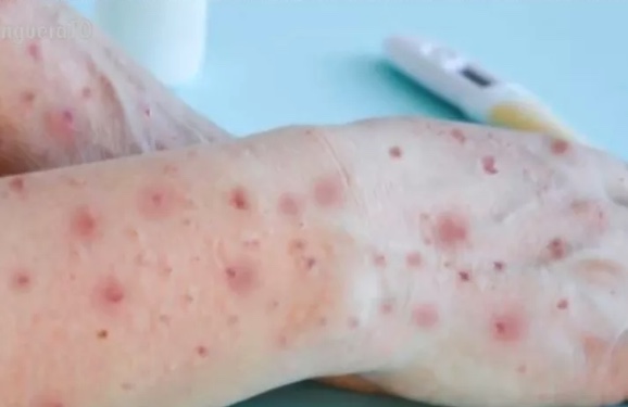 Amazonas registra aumento nas notificações de casos de varíola dos macacos