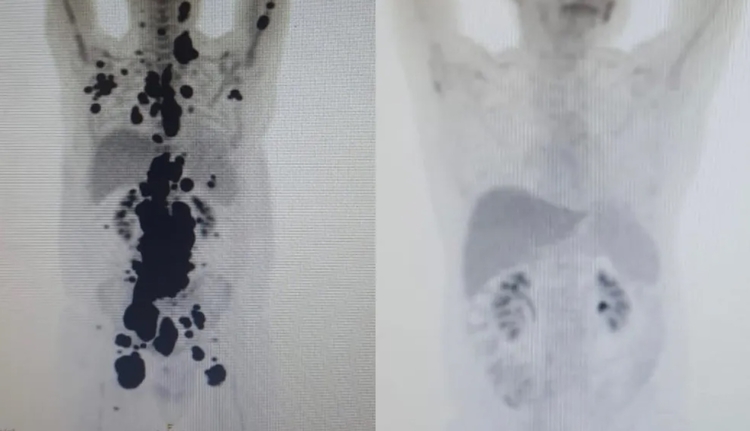 Anvisa aprova pesquisa com Car-T Cell no Brasil; paciente teve remissão completa de câncer