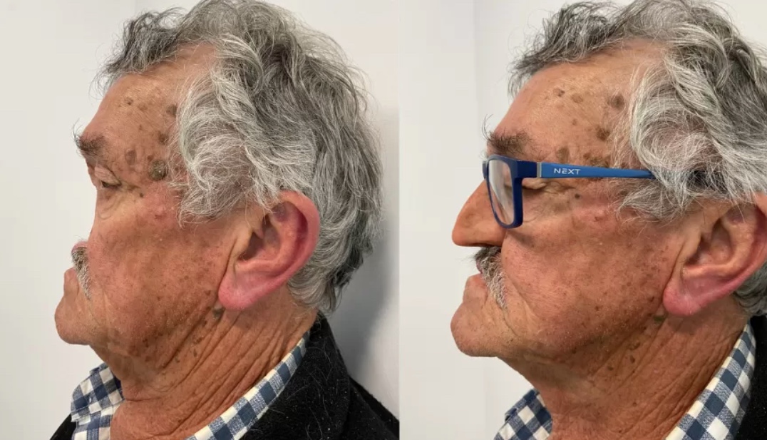 Há 2 anos sem nariz devido a câncer, idoso comemora prótese; veja