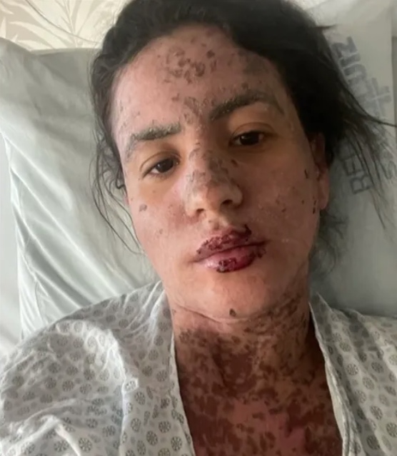 Síndrome de Stevens-Jhonson: Conheça doença rara que deixou mulher de Frank Aguiar na UTI