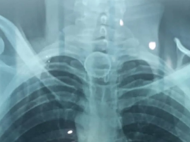 Homem engole tampa de cerveja ao abrir garrafa no Ano Novo no Amazonas