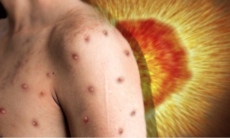 Amazonas chega a 245 infectados pela varíola dos macacos 