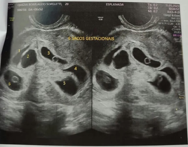 Mãe descobre estar grávida de sêxtuplos durante ultrassom para ver um bebê; pai passou mal