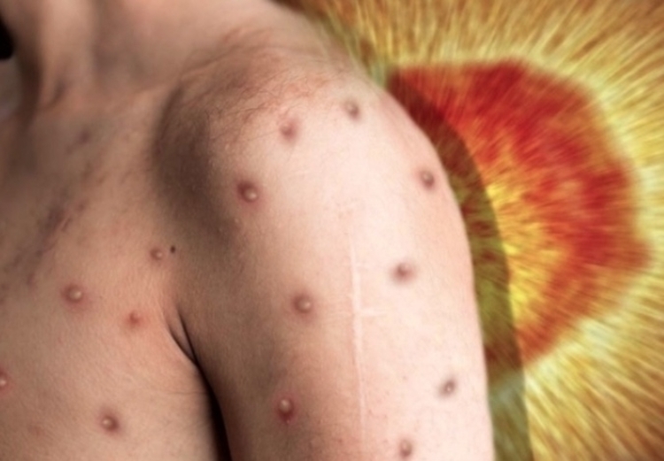 Com mais 6 infectados, Amazonas chega a 167 casos de varíola dos macacos