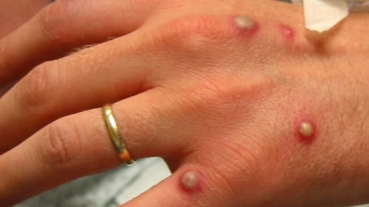 OMS declara varíola dos macacos como emergência global