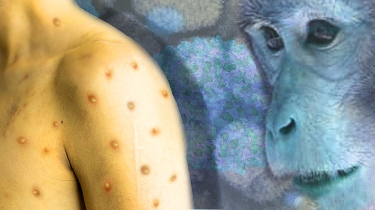 Sobe para 4 os casos suspeitos de varíola dos macacos no Brasil 