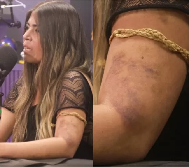 Bruna Surfistinha denuncia agressão do ex e mostra hematomas; medida protetiva é concedida 