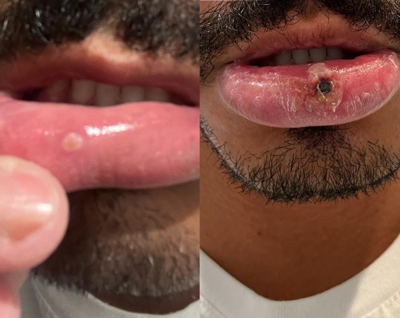 Advogado é diagnosticado com varíola dos macacos após achar que ferida era afta