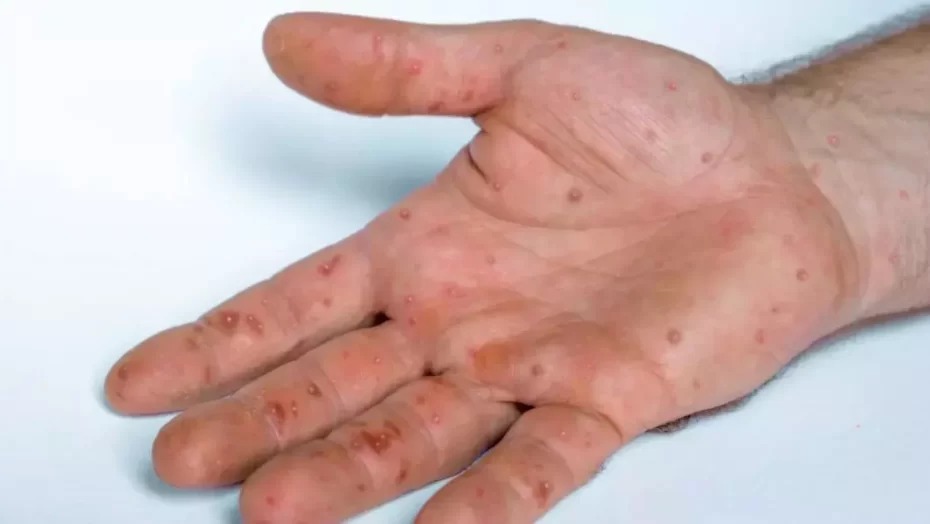 Anvisa autoriza uso emergencial de kits para varíola dos macacos