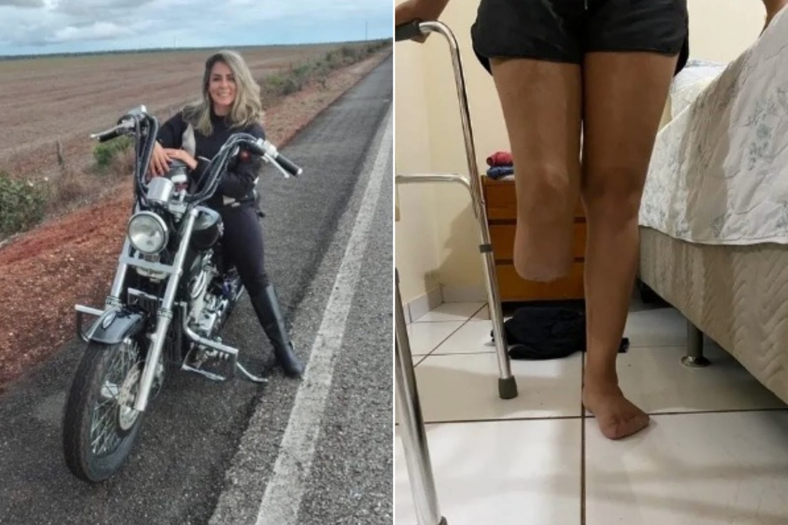 Mulher perde a perna e vários dedos após passar por lipoaspiração e entrar em coma