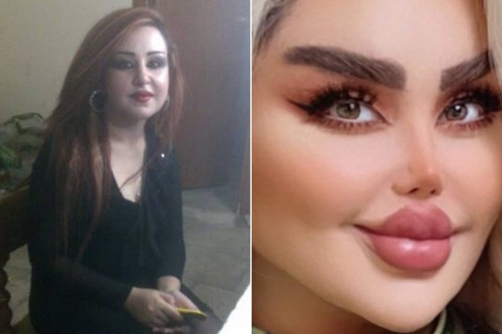 'Barbie iraquiana' choca ao aparecer irreconhecível após 43 cirurgias plásticas