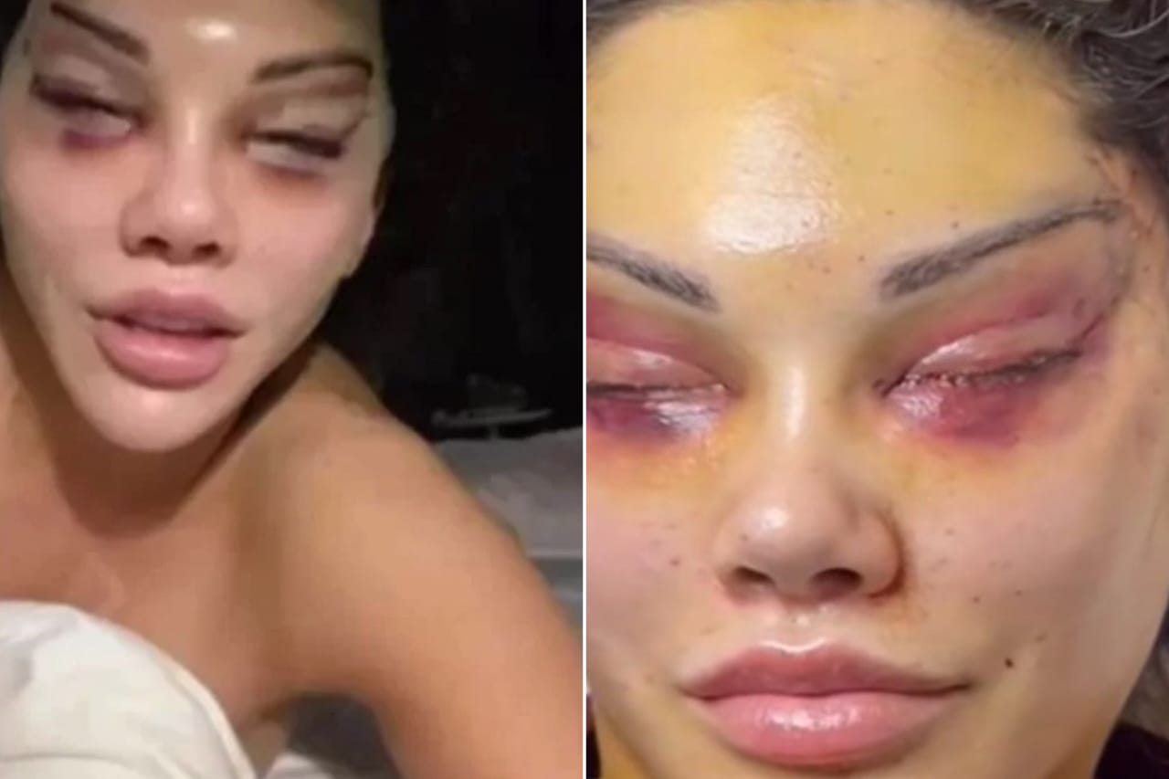 Influencer fica com o rosto deformado após cirurgia para ter 'olhos de gata': 'assustador'