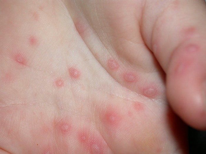 'Mão-pé-boca': 4 estados do Brasil enfrentam surto de vírus altamente contagioso entre crianças