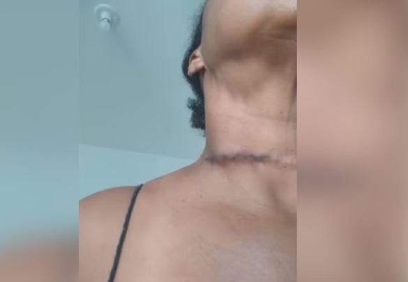 Mulher leva 10 pontos no pescoço após corte com linha de cerol