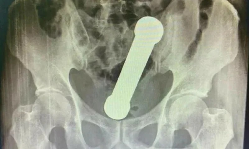 Homem usa peso de academia como ‘brinquedo sexual’ e vai parar no hospital em Manaus