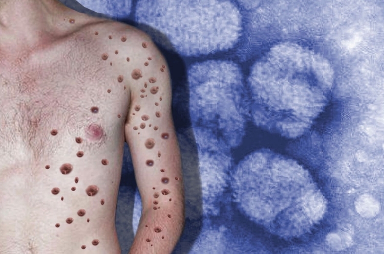 Sétimo caso de infecção por varíola dos macacos é confirmado no Brasil