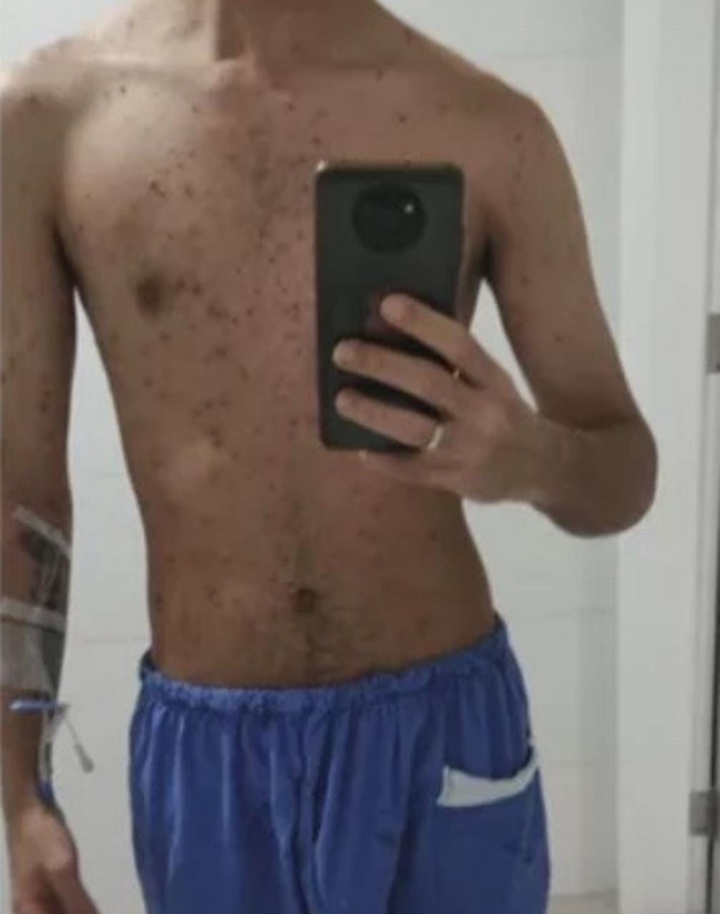 Paciente infectado com varíola dos macacos choca ao mostrar mais de 200 feridas no corpo