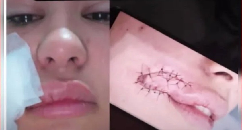 Homem arranca rosto de mulher a dentadas durante assalto