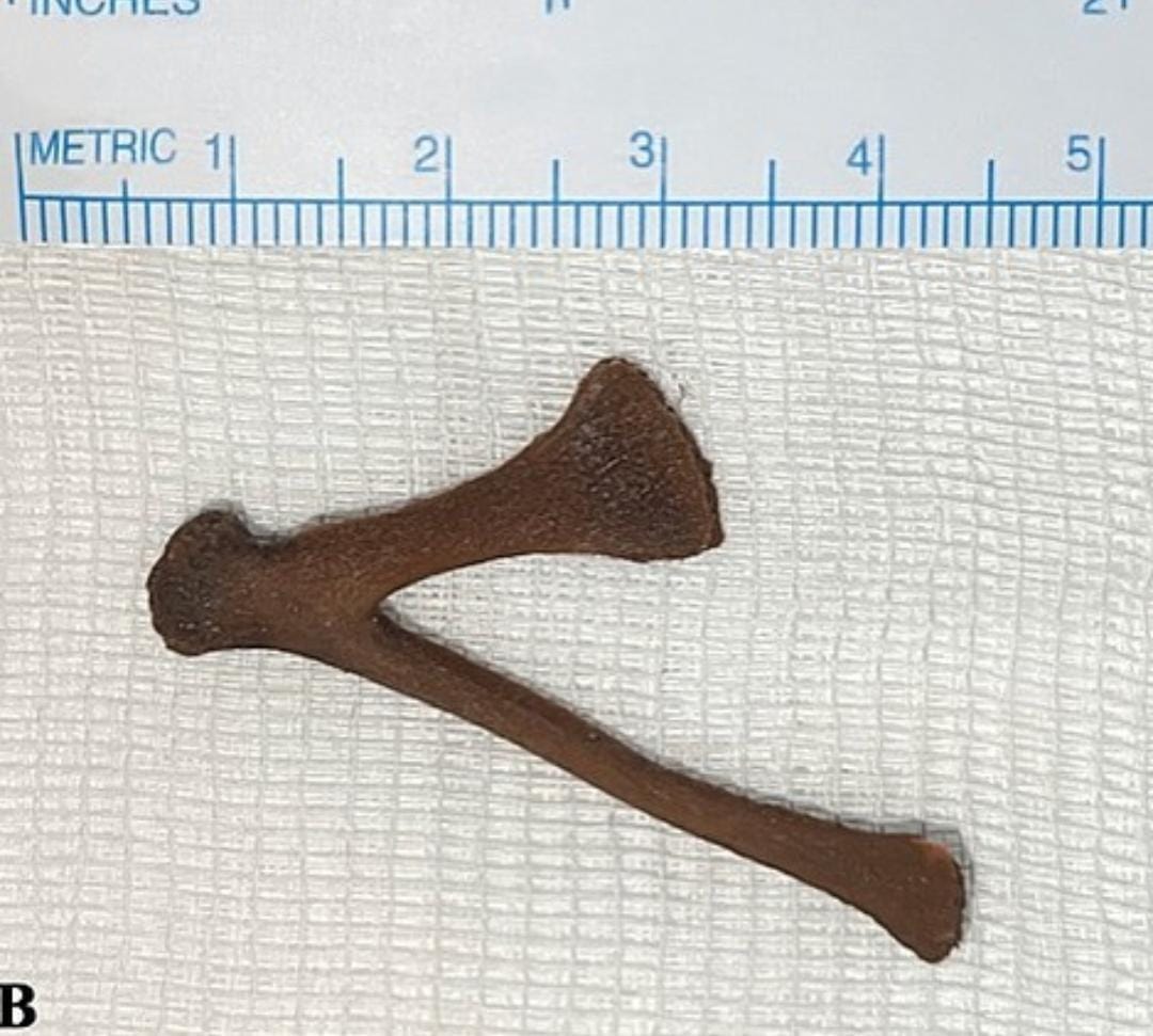 Mulher é levada às pressas para hospital após osso de galinha ficar preso no ânus