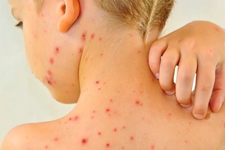 FVS esclarece que casos em escolas de Iranduba são de catapora, e não Mpox