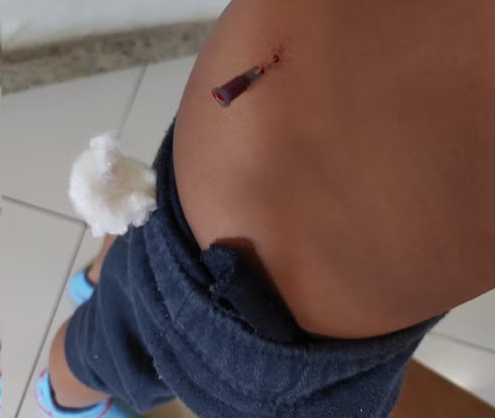 Enfermeira esquece agulha em criança de 5 anos após atendimento em hospital
