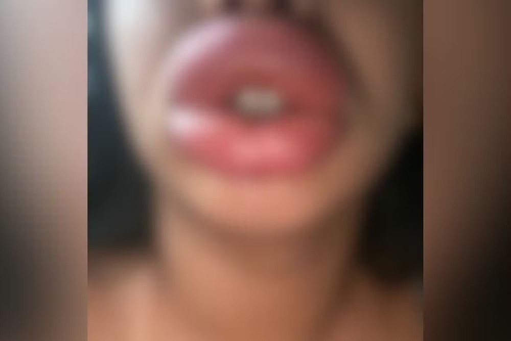 Polícia investiga mulher que prometia 'boca de Angelina Jolie' e deixou clientes deformadas