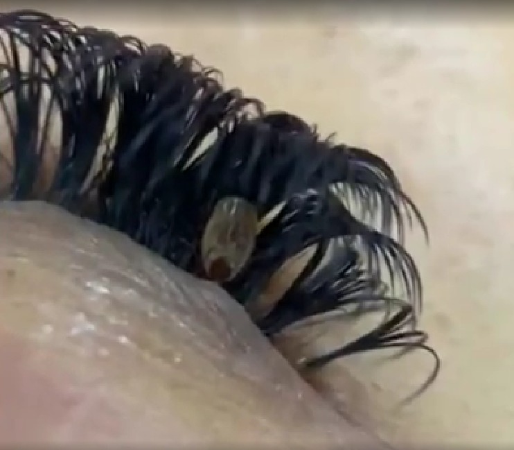 Designer encontra carrapato preso em cílios de cliente 