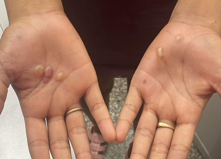 Mulher é presa por torturar garota de 12 anos com plástico derretido e palmatória em Manaus