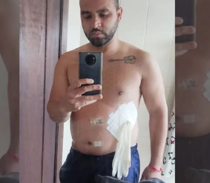 Médico coloca luva cirúrgica no lugar de bolsa de colostomia em paciente e causa revolta