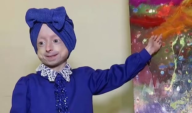 Criança de 10 anos morre de 'velhice' com condição genética rara