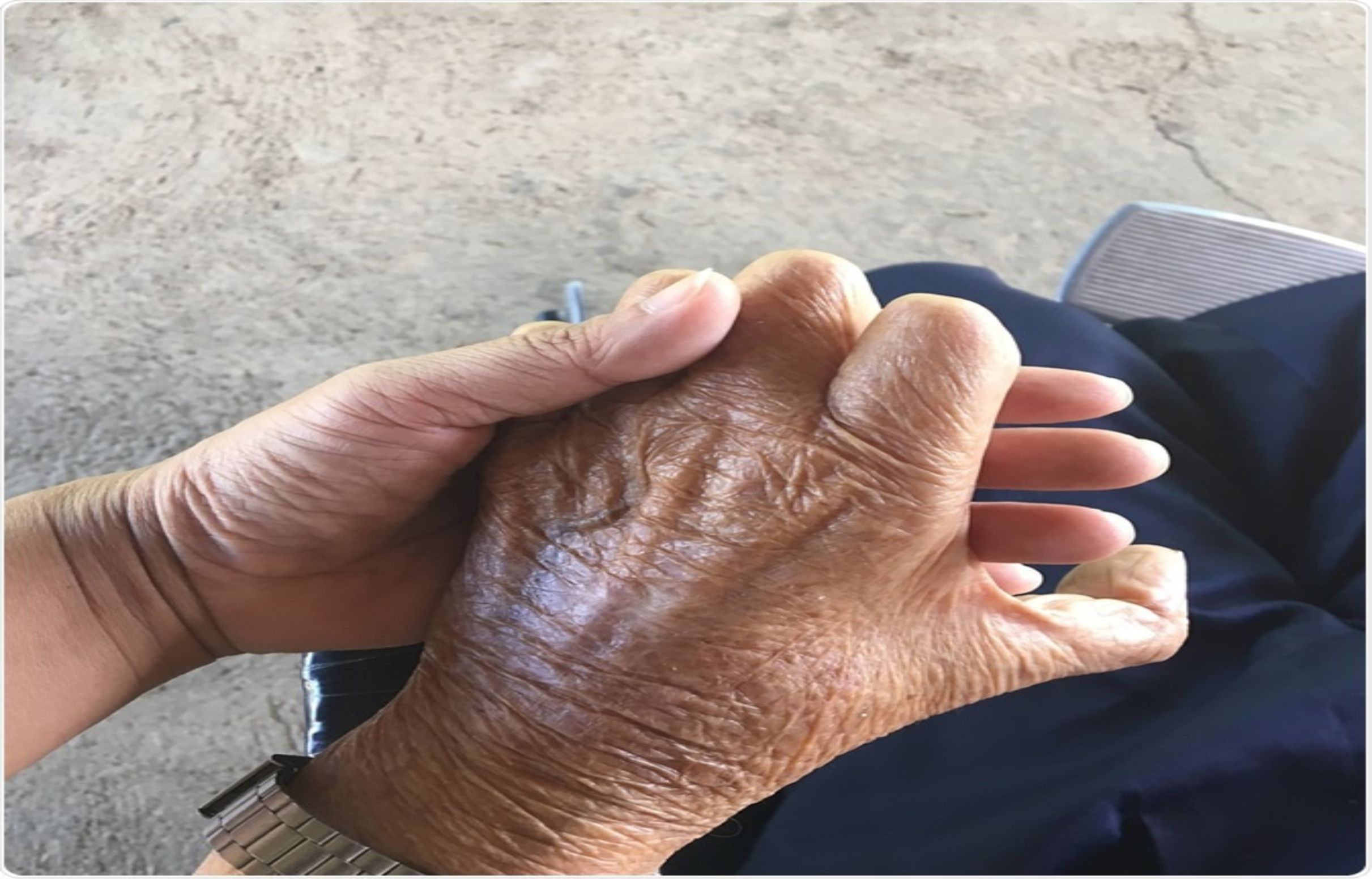 Diagnóstico tardio de Hanseníase eleva risco de mutilações em pacientes no Amazonas