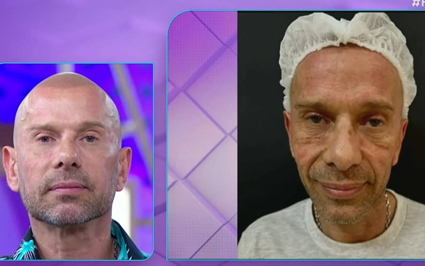 Rafael Ilha impressiona com resultado de harmonização facial 