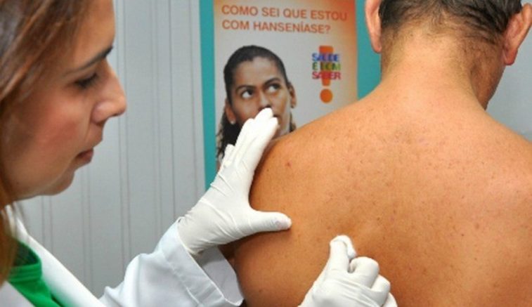 Lei que reajusta pensão de hansenianos é sancionada no Amazonas