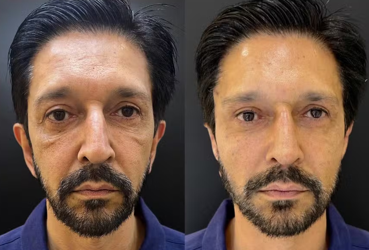 Prefeito de São Paulo Ricardo Nunes faz harmonização facial e mostra resultado