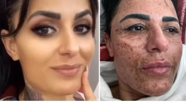 Esteticista queima rosto de cliente durante briga com namorado por telefone