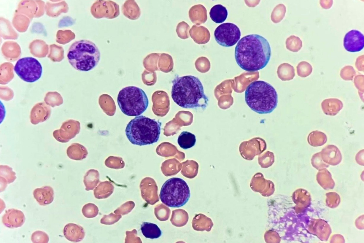 SES-AM alerta importância do diagnóstico precoce da Leucemia Mieloide Crônica 