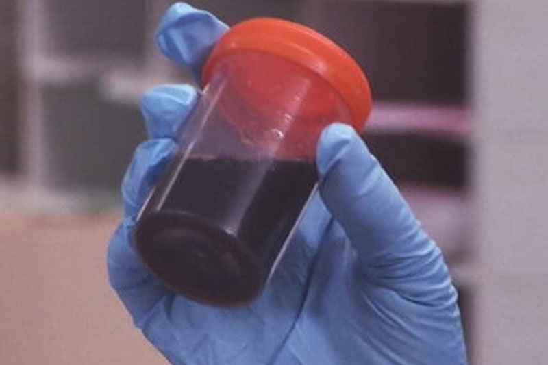 Maués confirma 3 novos casos de ‘doença da urina preta’ com internações no Amazonas