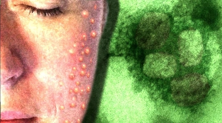 Brasil negocia compra de vacina contra varíola dos macacos