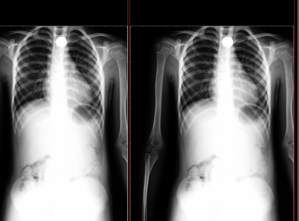Família entra em pânico após criança ficar 12 horas com moeda na garganta