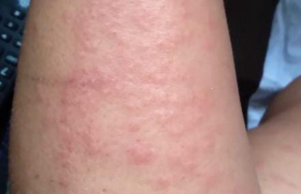 Surto de lesões na pele e coceira intrigam médicos em Pernambuco; Confira