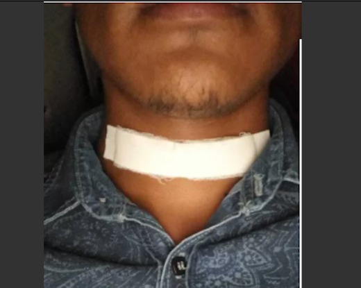 Jovem pensou que ia morrer ao ter garganta perfurada por pássaro