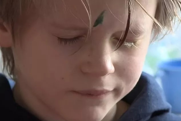 Criança fica 4 dias sem abrir o olho após pai confundir supercola com colírio