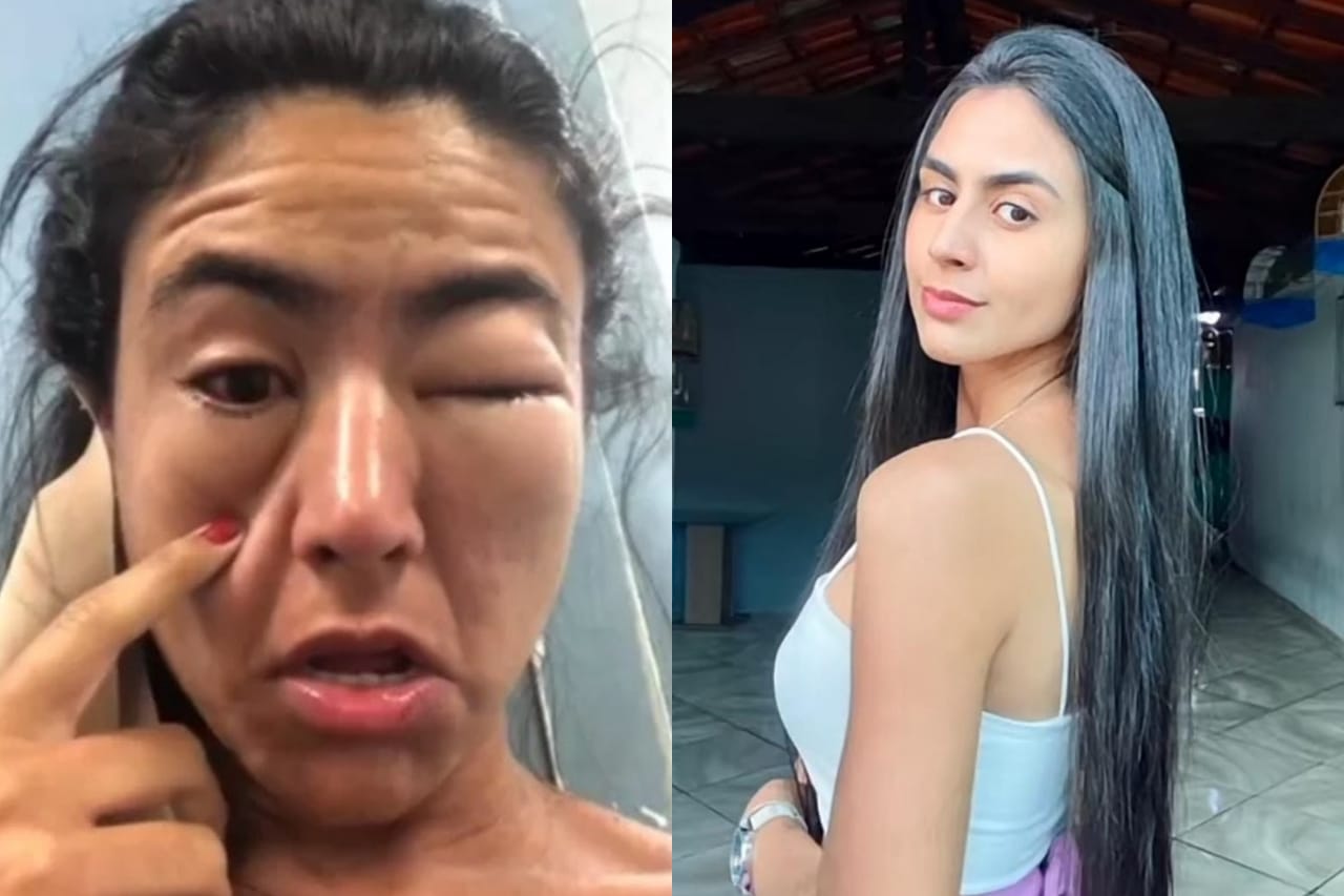 Estudante fica com o rosto deformado após reação alérgica a camarão