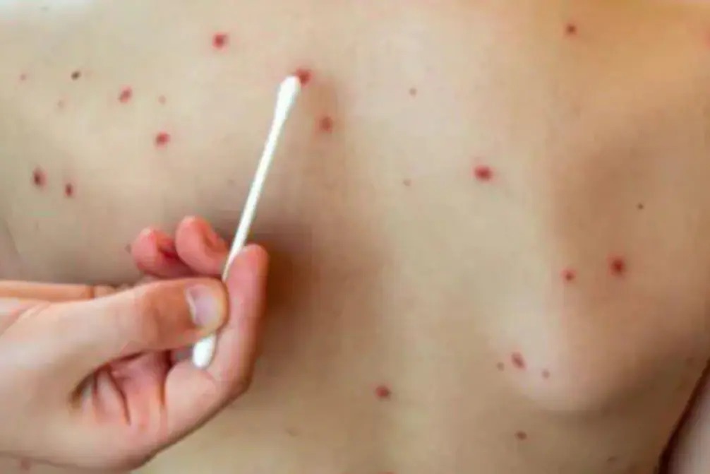 Gripe do tomate: veja 8 sintomas da infecção identificada em mais de 100 crianças na Índia