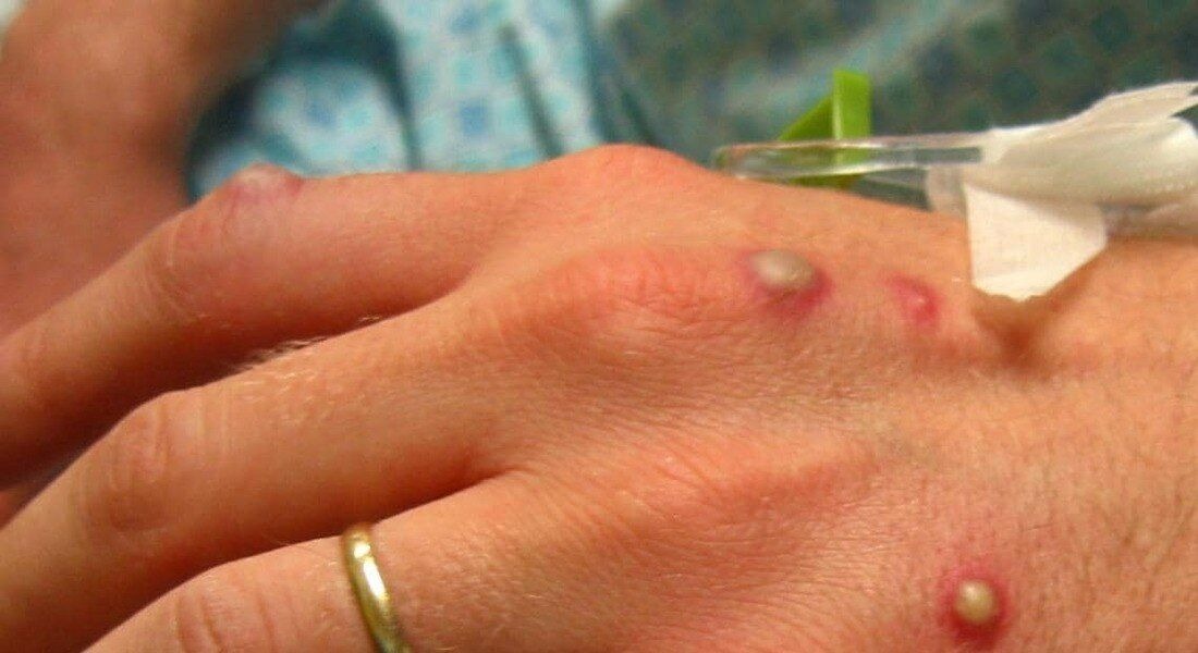 Rio de Janeiro registra primeira morte por varíola dos macacos; 2ª no País