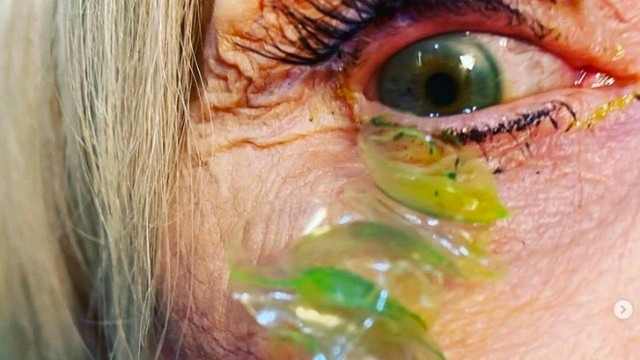 Vídeo: Oftalmologista retira mais de 20 lentes de contato perdidas em olho de paciente