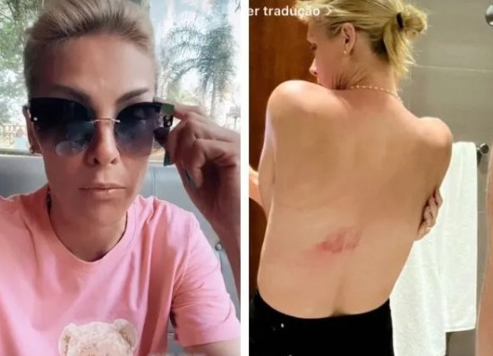 Ana Hickmann sofre acidente ao cair de cavalo